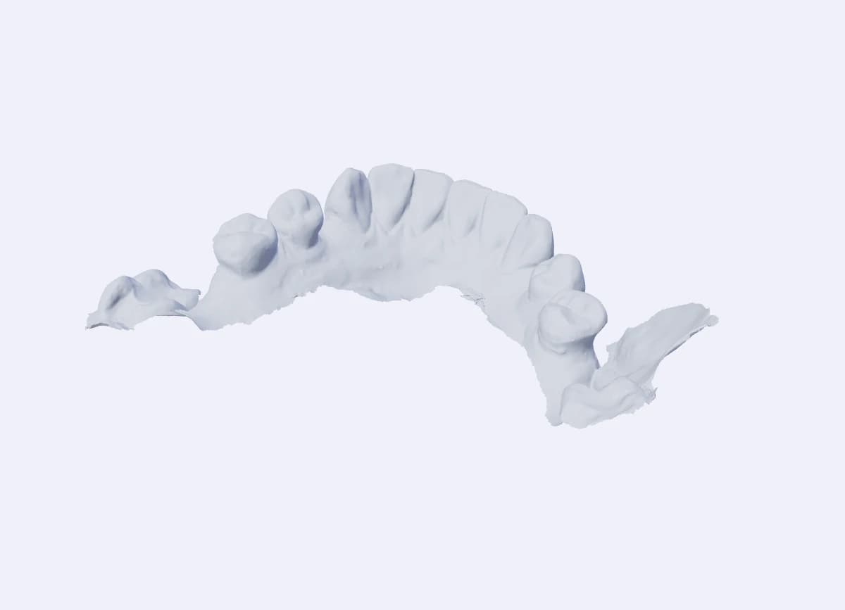 Original dental scan with excess soft tissue and a large unwanted artefact on the right